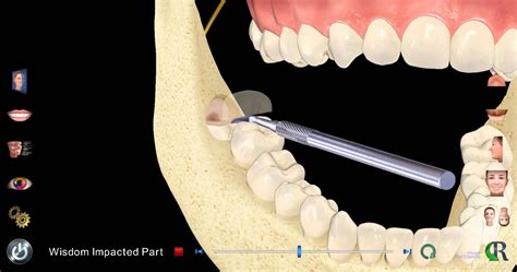 Tooth extraction has to be high up there on the list. Partial Impaction Wisdom Tooth Extraction | Tooth extraction healing, Homemade toothpaste, Dental