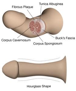 Newest best videos by rating. Health Blog » Evaluation and Treatment of Peyronie's disease