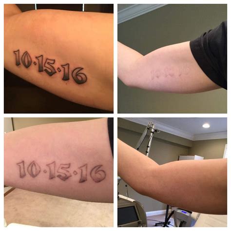 Read writing from lexington tattoo removal on medium. Before & After | Kentucky | Lexington Tattoo Removal
