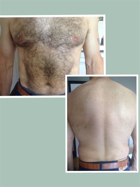 The procedure is ideal for men interested in body hair removal, facial hair removal, back hair removal or permanent hair removal from the chest. Laser hair removal for men! - Bare UK
