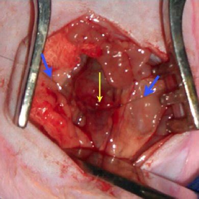 Colonic resection with primary anastomosis and defunctioning ileostomy. Delcio MATOS | PostGraduate Professor | Universidade ...