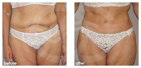 Lipo derm ultraschall kavitation durch ultraschallwellen. TUMMY TUCK Before After Photos Abdominoplasty Removed Fat ...