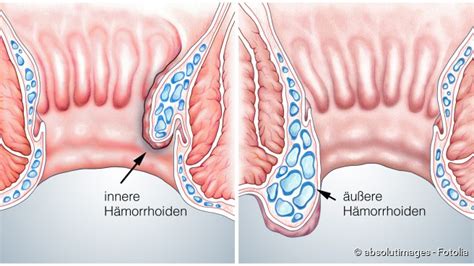 Wegen des blutverlustes in den verdauungstrakt hinein kommt es zu einer kreislaufschwäche mit. Hämorrhoiden: Behandlung, Symptome, Vorbeugung - NetDoktor.de