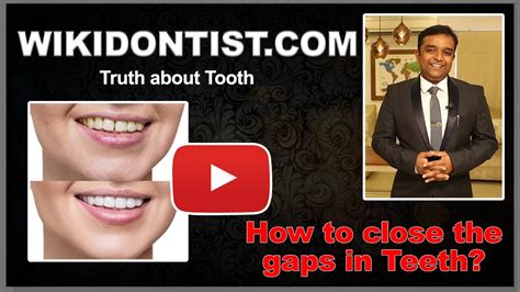 The gap between your teeth can be a real charmer or it can spoil your personality. Tooth Gaps and more on Smile Designing / How to close the ...