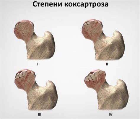 Коксартроз тазобедренного сустава диета питание Лечится ли коксартроз тазобедренного сустава 2 степени? - Доктор Позвонков Лечится ли коксартроз тазобедренного сустава 2 степени? - Доктор Позвонков Коксартроз тазобедренного сустава диета питание