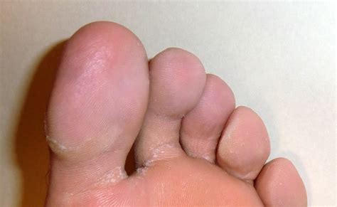 Wash the area around your toe. Black Spot Under Big Toenail - change comin