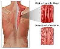 Once it does, incorporate regular calf stretches or foam rolling into your routine. Image result for micro tears in muscle fibres | Muscle ...