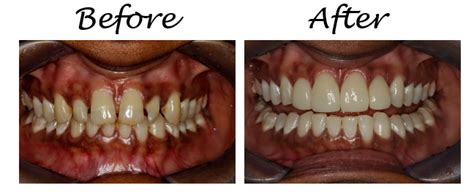 5 is it gap tooth or gap teeth? How To Fix The Gaps Between Your Teeth