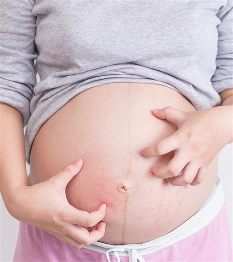 Home remedies for itchy stretch marks Kim Hilton ...