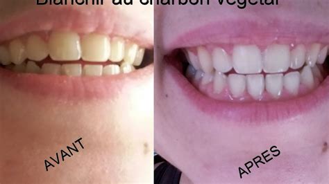 Pour finir, une autre étude14‌ a révélé aucun effet blanchissant du charbon actif sur les dents. Avis charbon vegetal actif dent Notre Test 2020