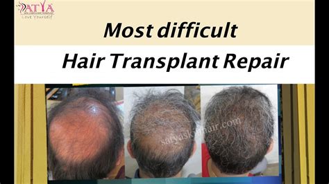 He graduated from the university of miami school of medicine and. Most Difficult Hair Transplant Repair Surgery ( USA): 2019 ...