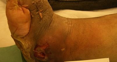 Aufgrund der schwere der erkrankung ist es wichtig. Notfall eines septischen Charcot-Fußes | SpringerLink