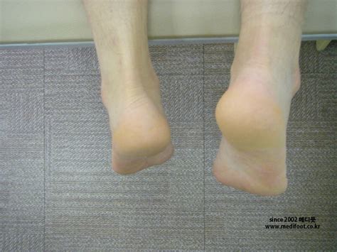 난 매일 다른 사람의 발을 보고 산다. :: 다리길이차이로 너무 빨리 찾아온 무릎통증