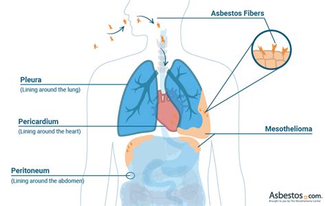 More rarely it starts in the layer of tissue in the abdomen that surrounds the digestive system organs (the peritoneum). Mesothelioma Causes, Symptoms and Treatment, Mesothelioma ...