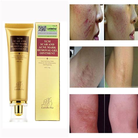 Revitol scar removal cream is the perfect product for this. Acne Scar Removal Cream, TCM Scar and Acne Mark Removal ...