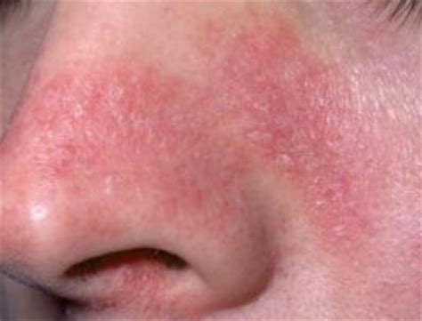 Seborrheic dermatitis is a possibility given your description and chronic. Rash on Nose, around Mouth, Upper Lips, Dry Skin, Causes ...