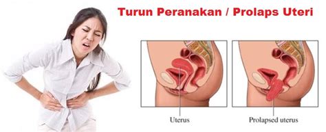 Zat besi memiliki fungsi memproduksi sel darah merah baru dan menaikkan jumlah trombosit. Cara Menyembuhkan Prolaps Uteri Secara Alami Tanpa Operasi ...