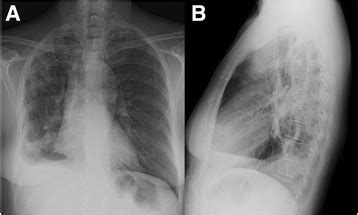 The pleura is a thin membrane that lines the surface of your lungs and the inside of your chest wall. Chest X-ray showing peripheral pulmonary infiltrates ...