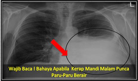 Sistem pernafasan manusia terbahagi kepada bahagian atas dan bahagian bawah. Wajib Baca ! Bahaya Apabila Kerap Mandi Malam Punca Paru ...