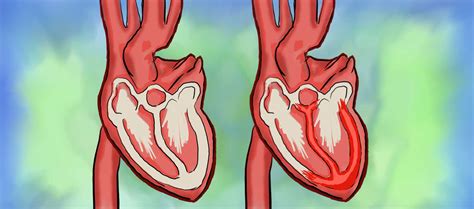 In almost all cases among vaccinated young people (they were ages 16 to 24), the symptoms have gone away quickly. Myocarditis: Symptoms, Diagnosis and Prevention ...