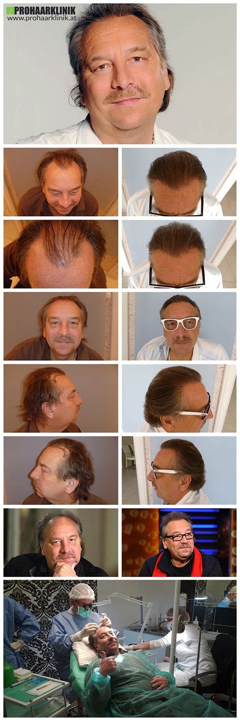 Vorher nachher 70 cm natürliches glattes leicht voluminöses europäisches schnitthaar. Haartransplantation Vorher Nachher Bilder der ...