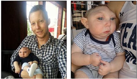 The most common type of jaundice is called physiologic jaundice, which can affect up to 60% of full term babies in the first week of life. Baby Jaxon, Born With Anencephaly, Defies the Odds, Turns ...