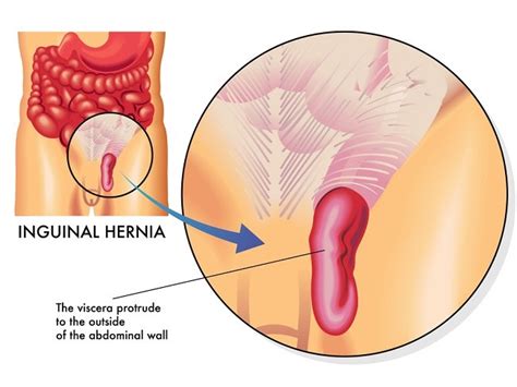 Benjolan ini muncul terutama pada saat bayi menangis. Hernia Inguinalis - patofisiologi, diagnosis ...