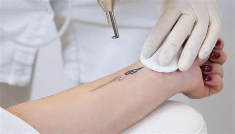 Many people say it feels unpleasant but definitely not unbearable. How Bad Does Tattoo Removal Hurt Reddit