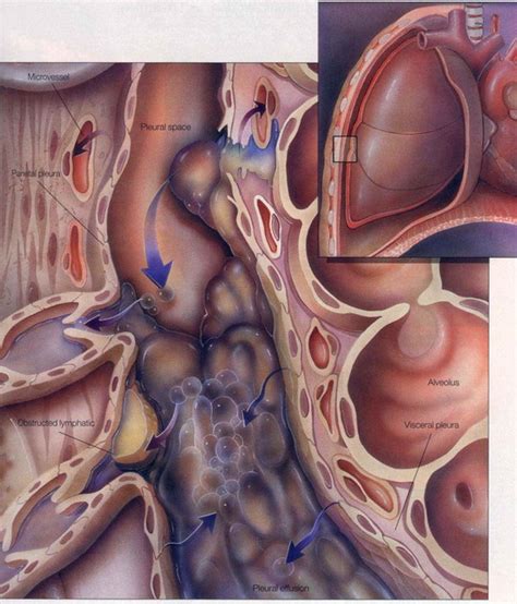 The act or an instance of effusing. الارتشاح البلوري ، انصباب جنبي Pleural effusion | طبيب