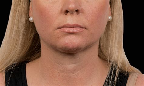 The costs of kybella® can vary by the amount of fat to be removed and the number of treatments performed. How Much Does CoolMini Double Chin Treatment Cost ...