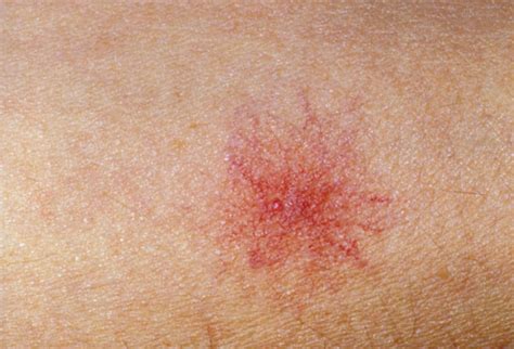 Inflammatory breast cancer affects breast tissue and can appear unusually dimpled or thick. Maayonglawas