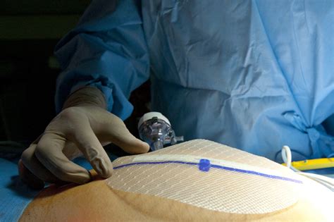 Mesh news desk is preparing a series of stories on hernia mesh as litigation begins to focus on this polypropylene medical device. Surgical Mesh Used for Hernia Repair | Laparoscopic.MD