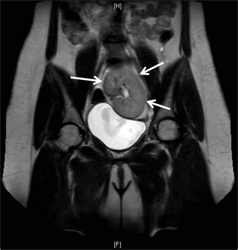 The mrkh is a rare congenital disorder which effects the female reproductive system. Mayer-Rokitansky-Küster-Hauser syndrome | BMJ Case Reports