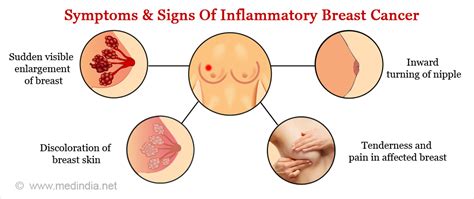 Breast cancer is a disease in which certain cells in the breast become abnormal and multiply uncontrollably to form a tumor. Inflammatory Breast Cancer - Medical Tech News : The ...