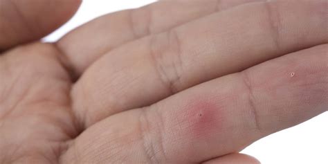 What a mistake that turned out to be. The Best Way to Remove a Splinter | Men's Health