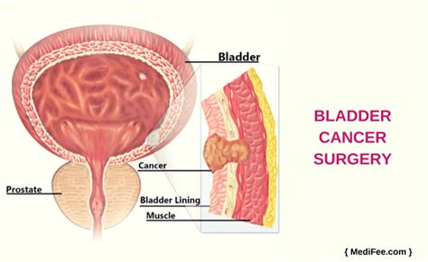 8 out of 10 people with bladder cancer (80%) have some blood in their urine. Bladder Cancer Surgery: Procedure, Risks and Associated ...