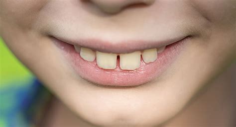 Check spelling or type a new query. Overbite | Causes and Treatments | Smile Works Dental