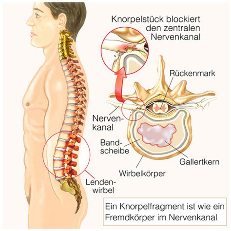 Wann sollte ein bandscheibenvorfall nicht voreilig operiert werden? Beschwerden - Bandscheibenvorfall - REAbalance