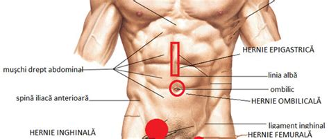 Plusieurs muscles (abdominaux et dorsaux) dont la disposition laisse plusieurs orifices anatomiques particuliers dénués de fibres. Hernie abdominale photo - Modalitati de a slabi