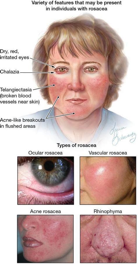 Whether you have rosacea or acne or both, they both have to do with inflammation in the bod. #PoppingPimples | Rosacea treatment, Rosacea symptoms, Ocular rosacea