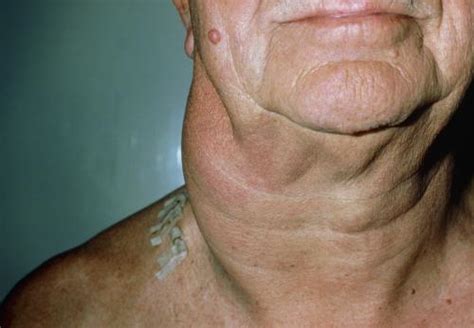 Swollen lymph node possibly throat cancer. Swollen Lymph Nodes - Heart and Blood Vessel Disorders ...