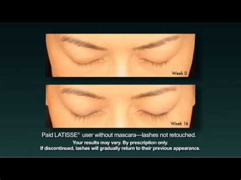 Do not apply to the lower eyelid. Latisse - YouTube