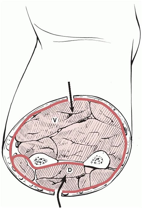 Some symptoms of acute compartment. Acute Compartment Syndrome - TeachMe Orthopedics