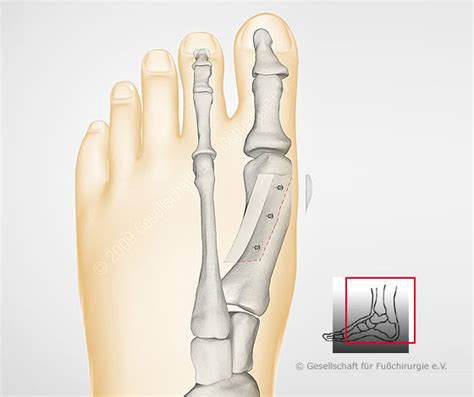 Index), dort bekommt man prima informationen. Hallux valgus - Gesellschaft für Fuß- und ...