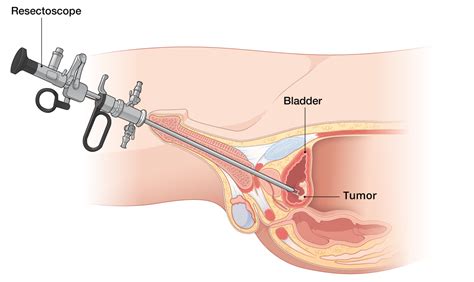 Dogs that have bladder cancer have symptoms that can easily be confused with bladder or yeast infections. What is Transurethral Resection of Bladder Tumor (TURBT ...