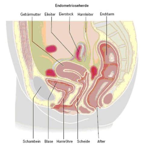 Request pdf | on apr 1, 2008, r länge and others published endometriosis genitalis externa im the impact of endometriosis on assisted reproduction outcomes: Allgemeine Gynäkologie - Leistungsspektrum