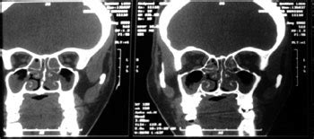 Mucormycosis is a rare, severe infection with fungi of the order mucorales. Mucormicosis rinosinusal en un paciente infectado por VIH