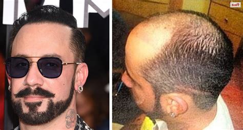 I think you would be surprised just how many celebrities have had hair transplants! Celebrity Hair Loss Before And Pictures Bald