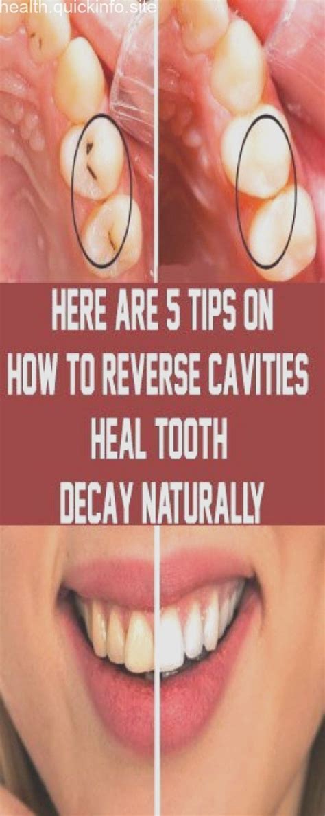 How my toddler developed tooth decay while eating a weston a. Here Are 5 Tips On How To Reverse Cavities & Heal Tooth ...