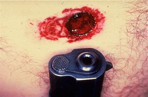 Gunshot wounds that pass through the body without hitting major organs, blood vessels, or bone tend to. Forensic Pathology